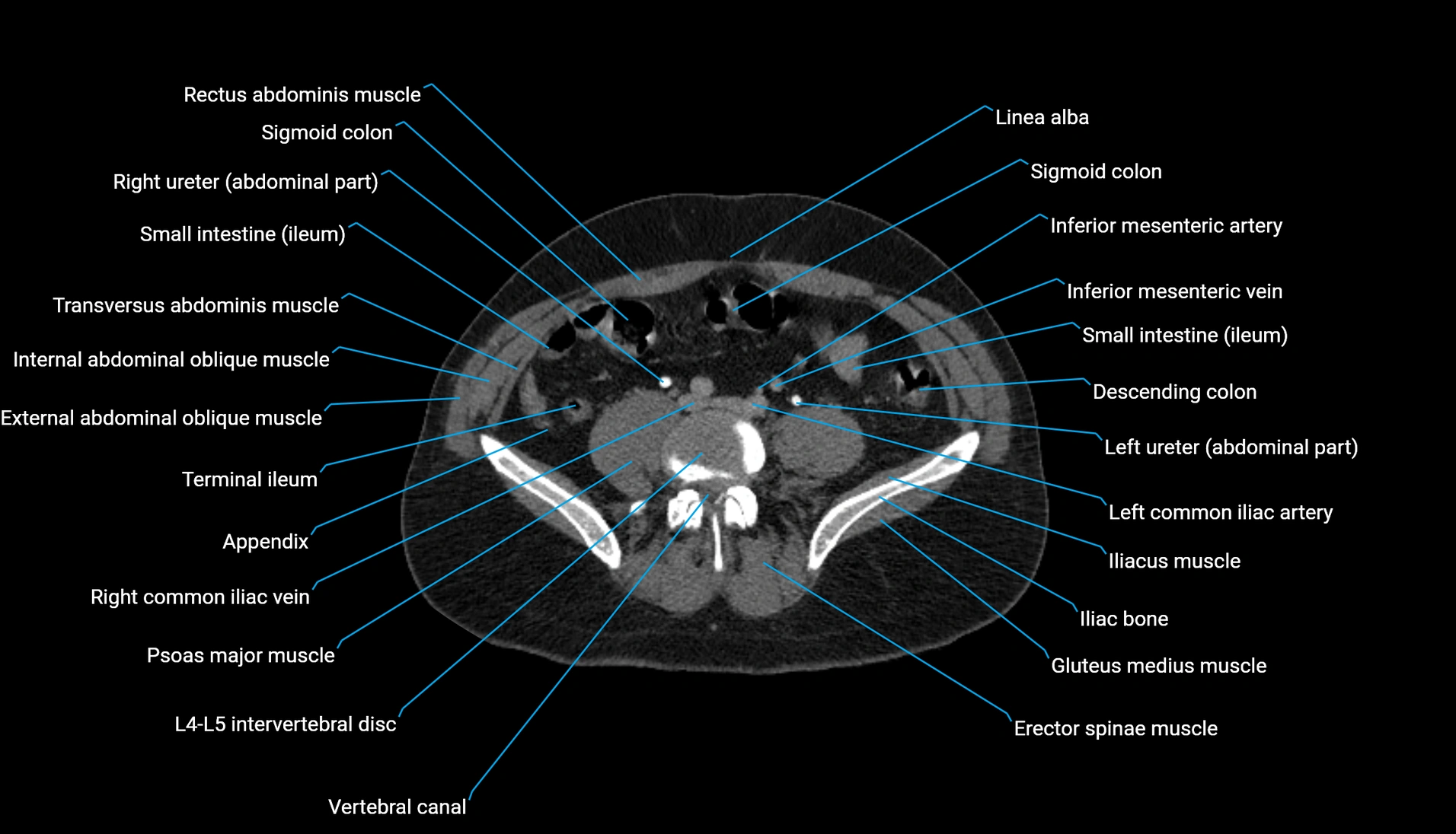 CT urogram axial cross sectional anatomy  labelled radiology image-00162.webp